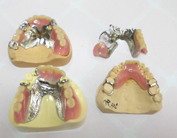 前歯の入れ歯の作り替えに関して