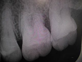 破折 レントゲン