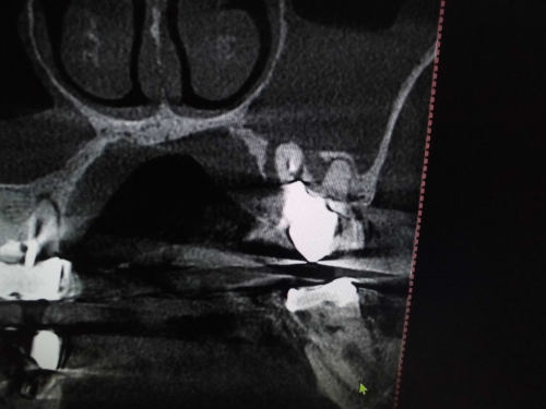 上顎洞への穿孔 粘膜の肥厚