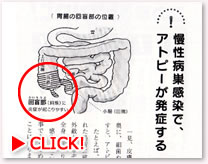 回盲部の慢性炎症