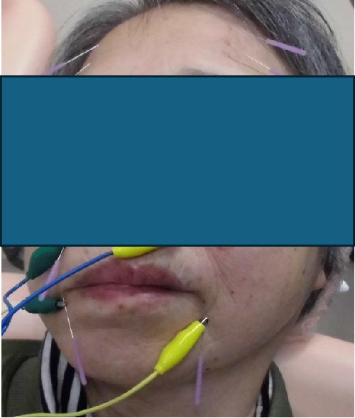 顔面神経麻痺(通電併用)