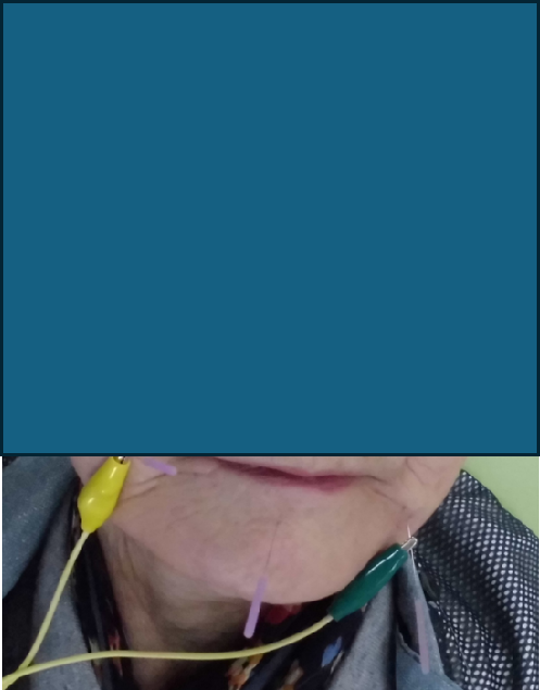 オトガイ神経麻痺(通電併用)