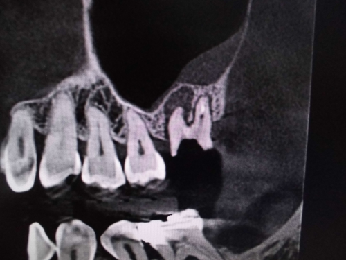 頬側近心根　上顎洞粘膜が肥厚　ct