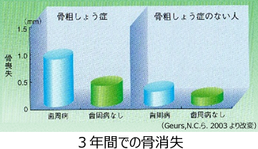 骨粗しょう症の骨